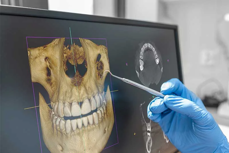 Planejamento de implantes sobre tomografia 3D na tela do computador