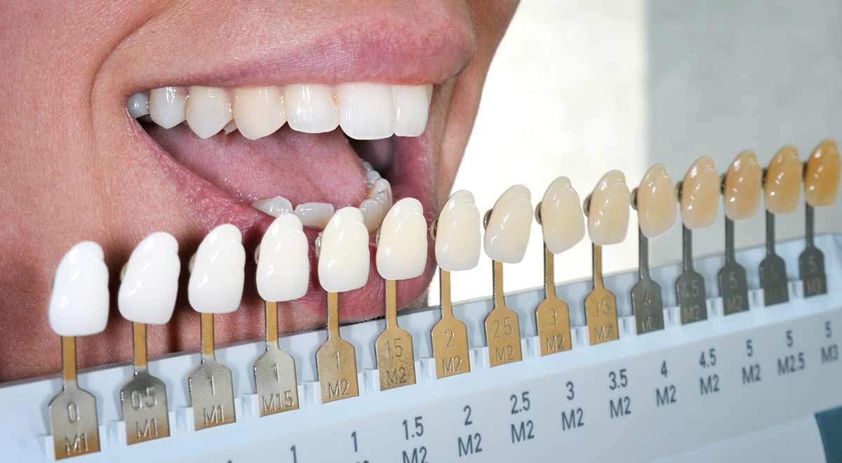 Mitos e verdades sobre clareamento dental