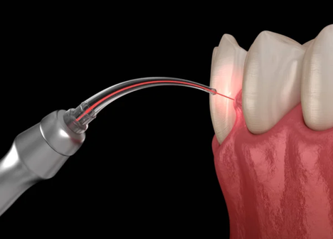 Tratamento periodontoal com qualidade é na Velasco odontologia