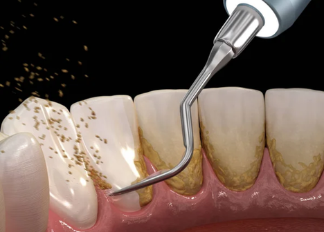 Tratamento periodontoal com qualidade é na Velasco odontologia