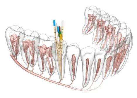 Tratamento de canal com especialista na Odontologia Velasco 