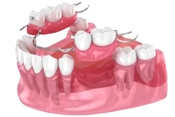 prótese removivel com grampos
