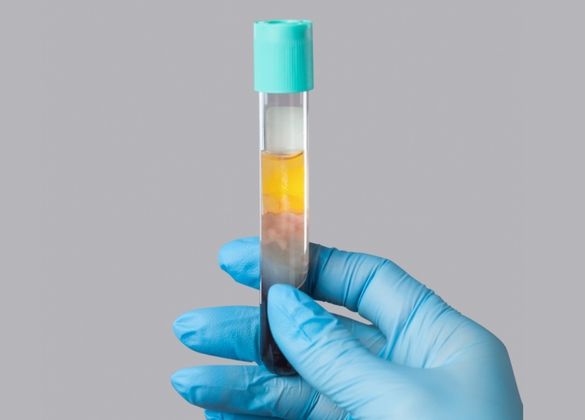 PRF, PRP, Plasmagel, agregado plaquetário, derivado plaquetário