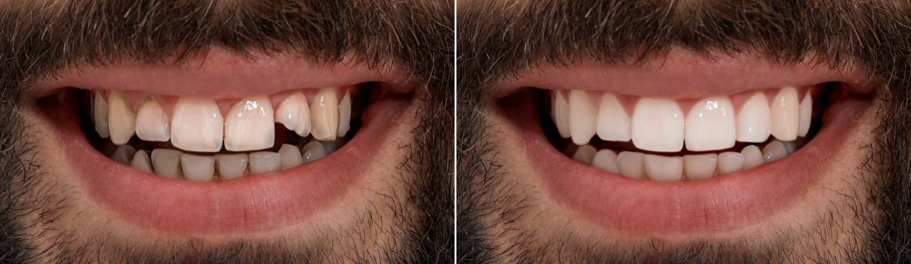 Estética Dental: Confira 5 principais procedimentos para o sorriso dos sonhos